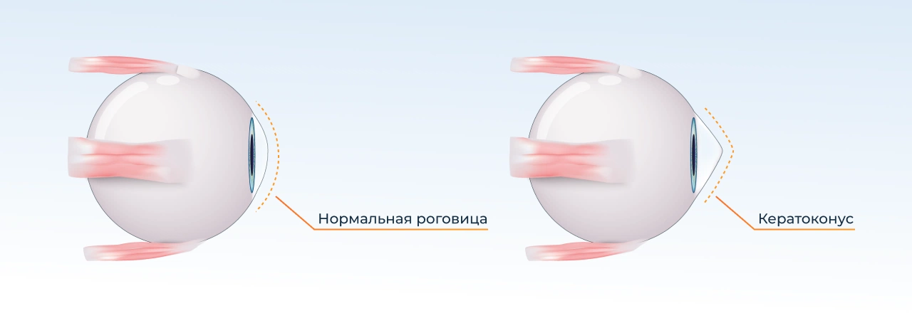 что такое кератоконус