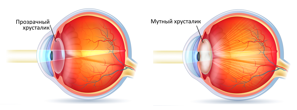 Почему снижается зрение?