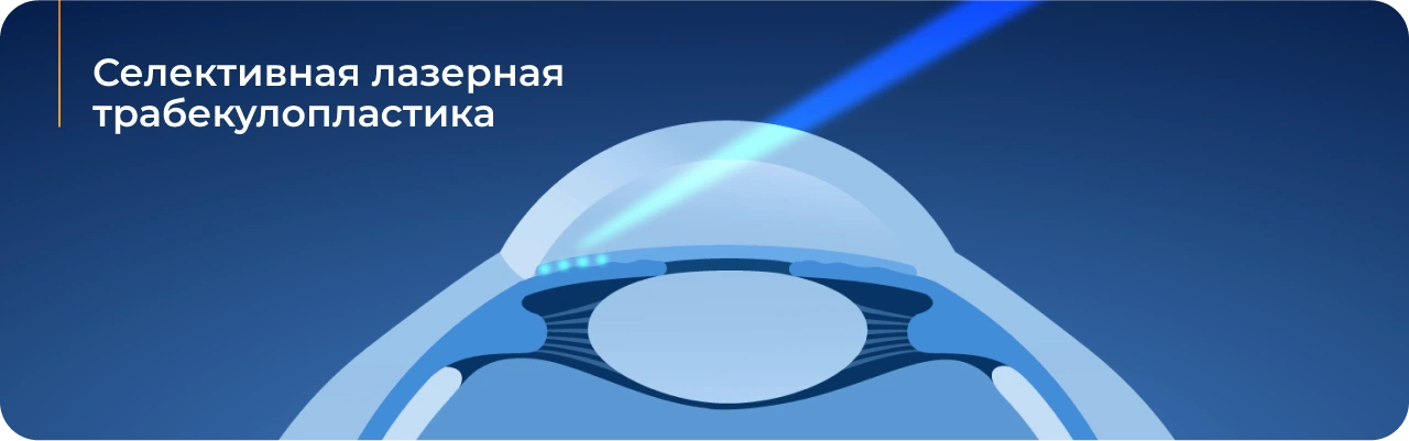 Операция селективная трабекулопластика