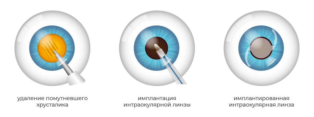 как проходит операция по удалению катаракты