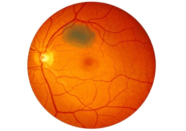 невус хориоидеи