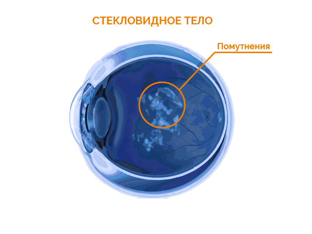 помутнение стекловидного тела
