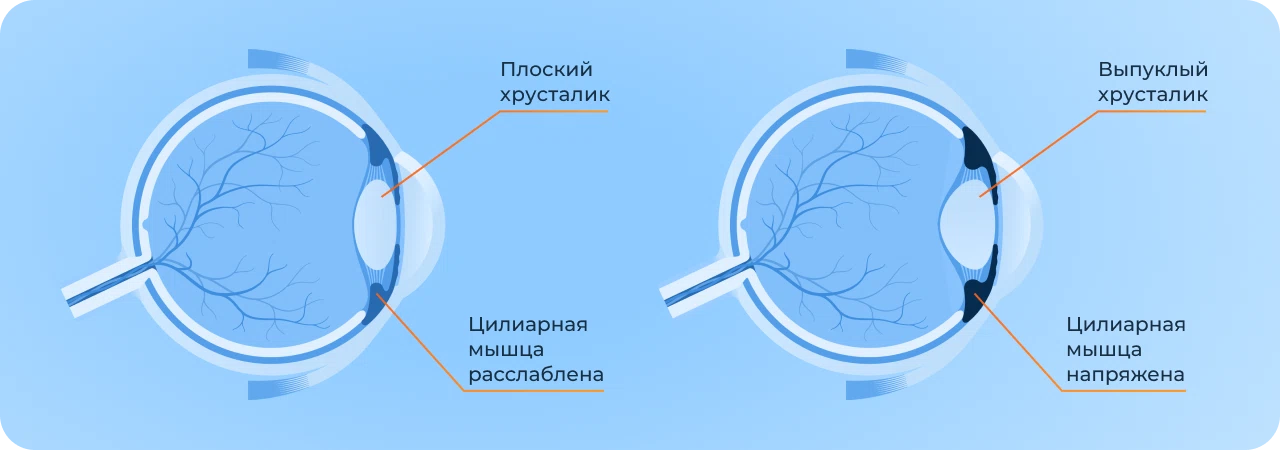 спазм аккомодации