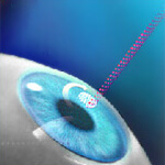 Intra Lasik, интра-ласик