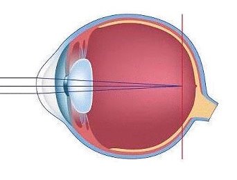 Близорукость