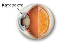 Катаракта глаза лечение в спб thumbnail